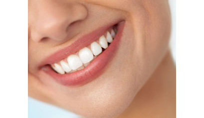 Hollywood-Lächeln dank Veneers – Ihr Zahnarzt in Rhodt macht es möglich